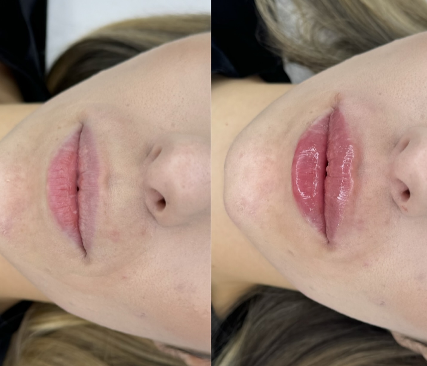 Volum și conturare faciala Lia Aesthetic Clinic