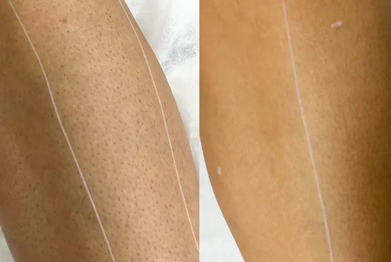 Specialist Lia Aesthetic Clinic realizând epilare definitivă cu laser diodă