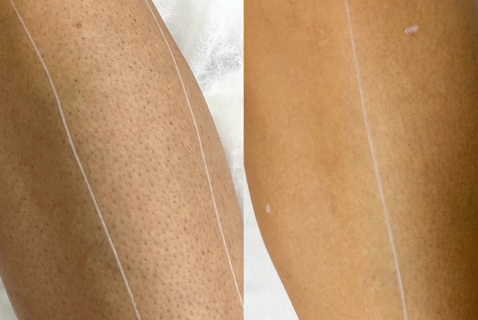 Epilare definitivă Lia Aesthetic Clinic