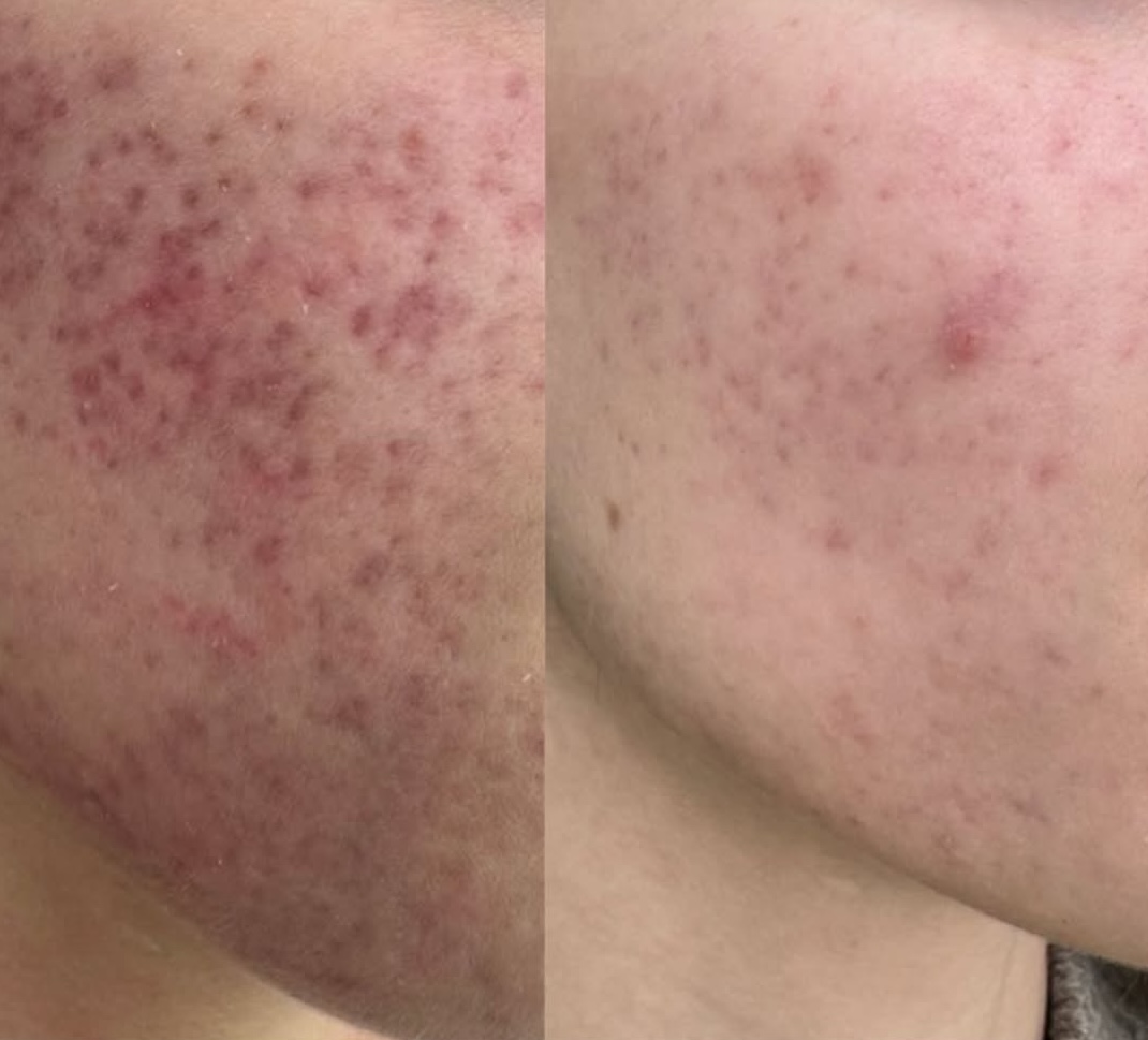 Acnee și cicatrici postacneice Lia Aesthetic Clinic
