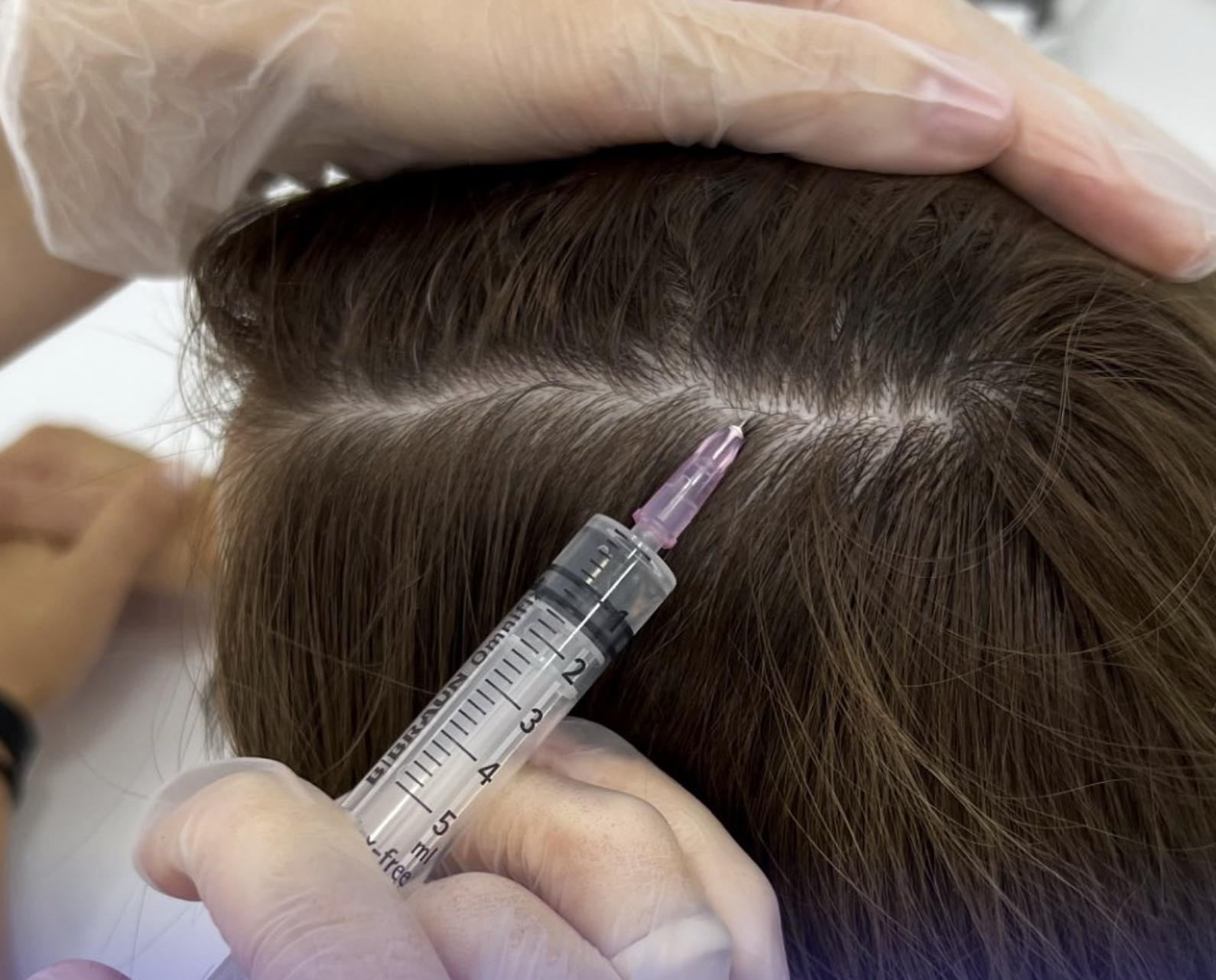 Tratament Cădere de păr și scalp Lia Aesthetic Clinic