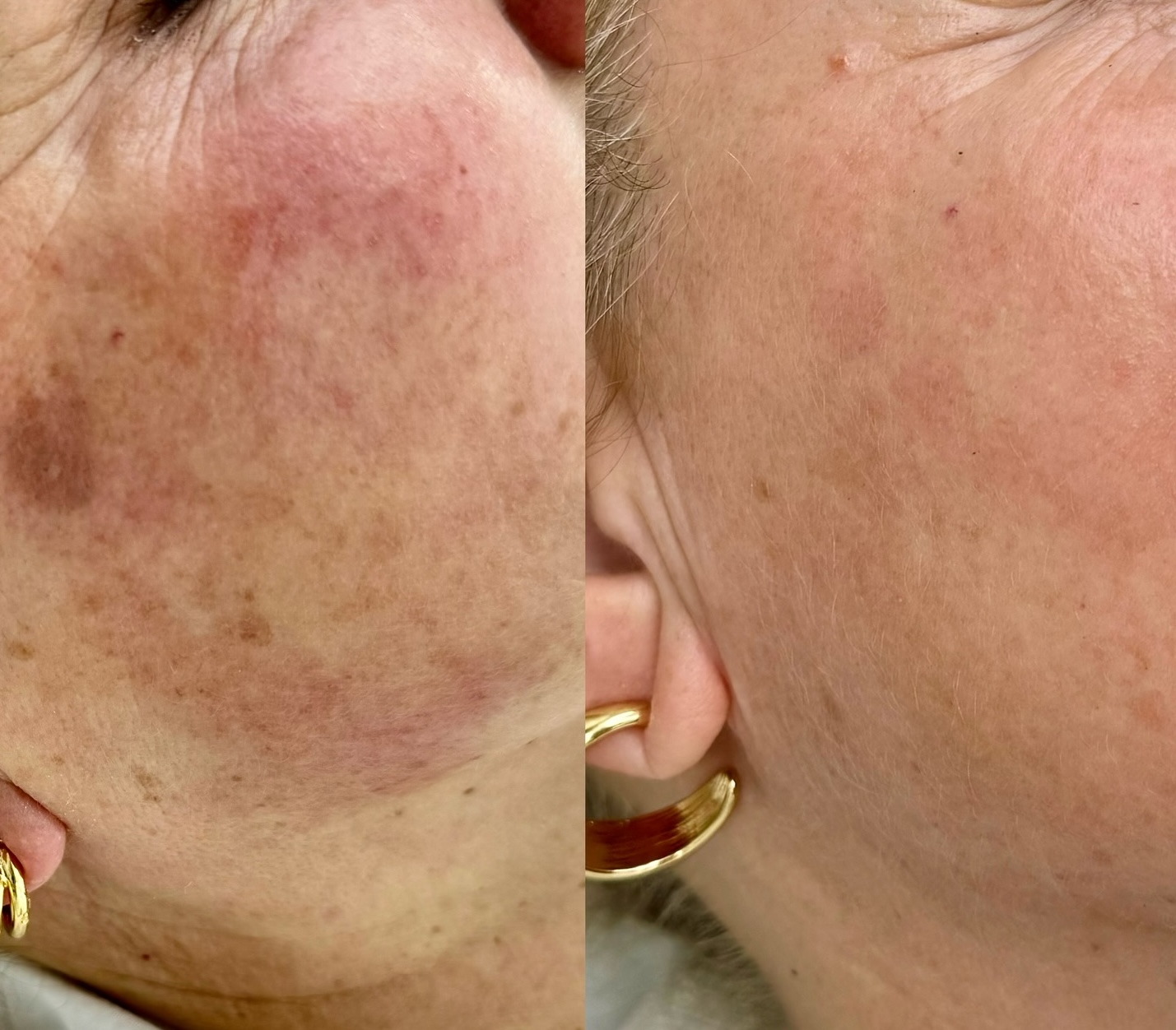 Pete pigmentare Lia Aesthetic Clinic