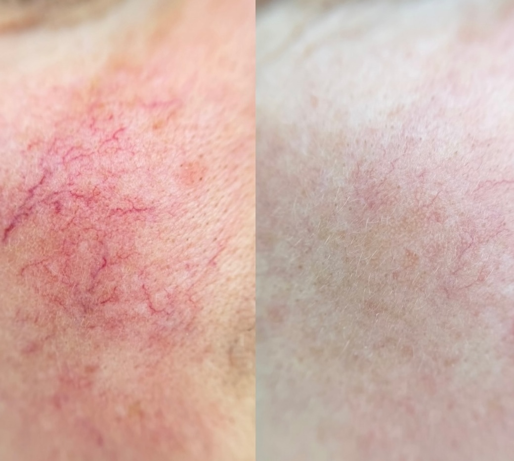 Tratament Roșeață și vase sparte Lia Aesthetic Clinic
